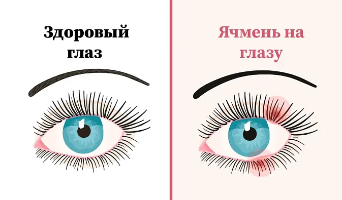 Ячмень на глазу