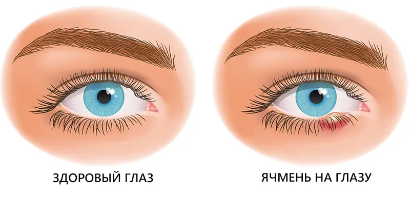 Ячмень на глазу