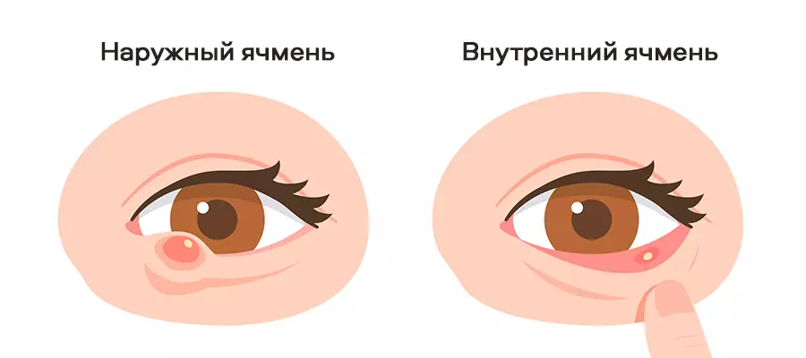 Ячмень на глазу